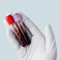 CA125, blood test